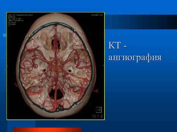 КТ ангиография 