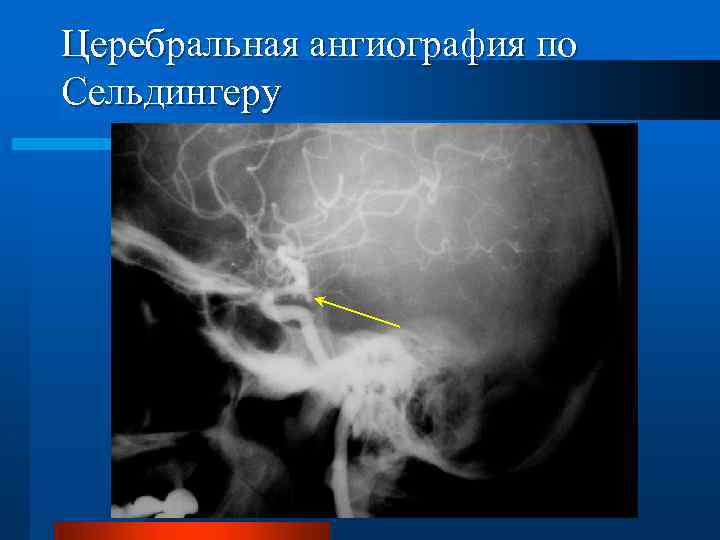 Церебральная ангиография по Сельдингеру 