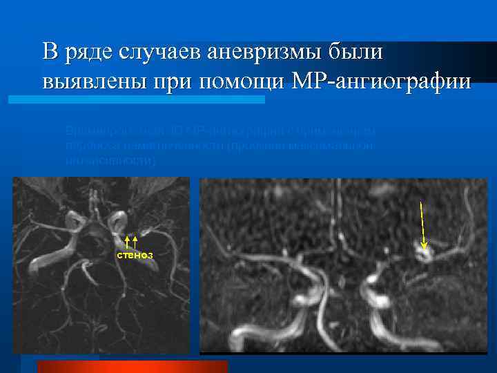 В ряде случаев аневризмы были выявлены при помощи МР-ангиографии Времяпролетная 3 D МР-ангиография с