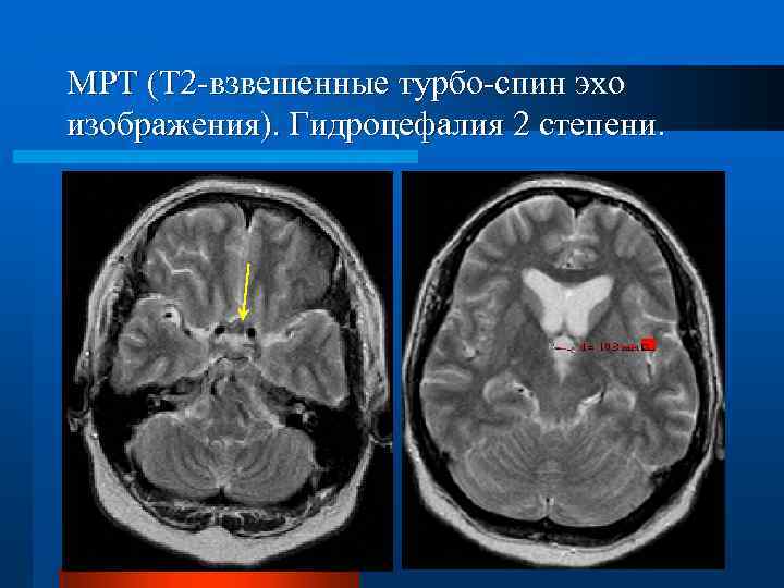 МРТ (T 2 -взвешенные турбо-спин эхо изображения). Гидроцефалия 2 степени. 