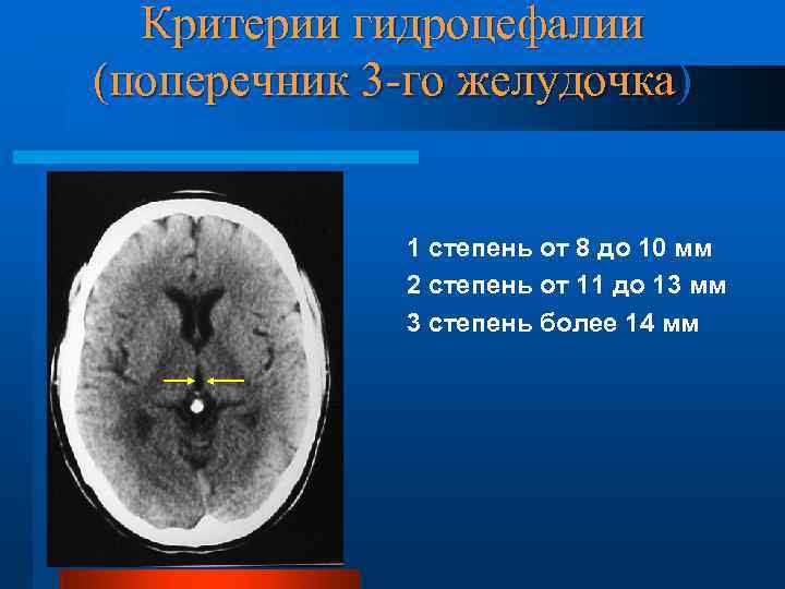 Критерии гидроцефалии (поперечник 3 -го желудочка) 1 степень от 8 до 10 мм 2