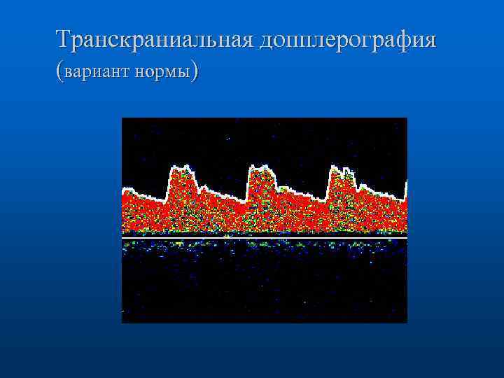 Транскраниальная допплерография (вариант нормы) 