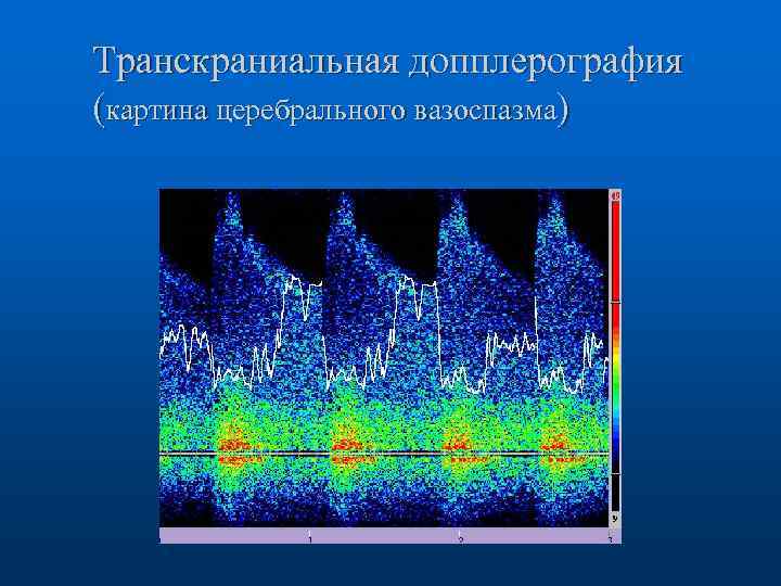Транскраниальная допплерография (картина церебрального вазоспазма) 