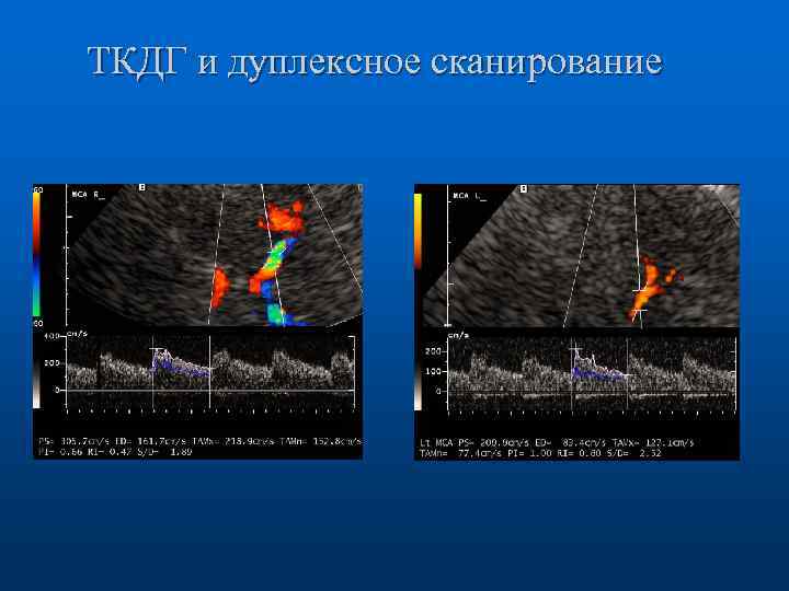 ТКДГ и дуплексное сканирование 