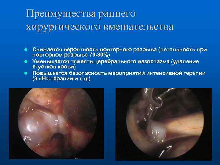 Преимущества раннего хирургического вмешательства Снижается вероятность повторного разрыва (летальность при повторном разрыве 70 -80%)