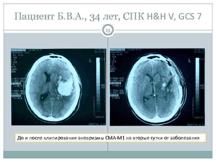Пациент Б. В. А. , 34 лет, СПК H&H V, GCS 7 15 До