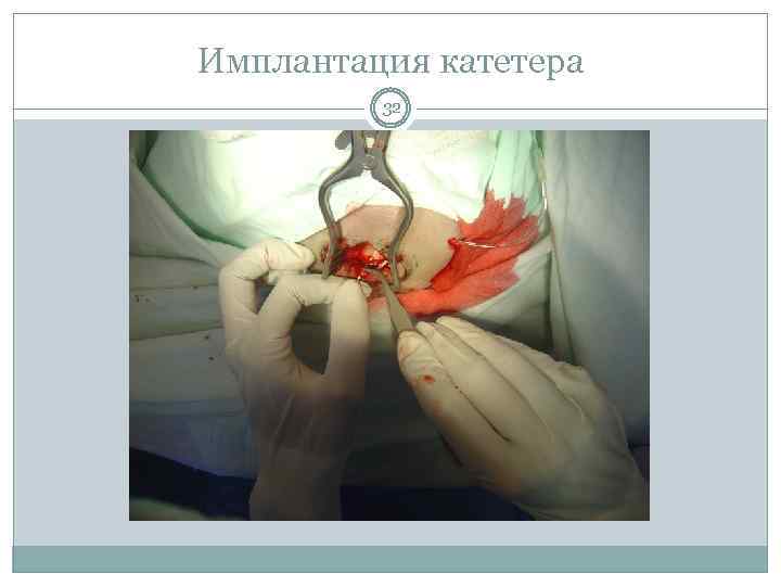 Имплантация катетера 32 