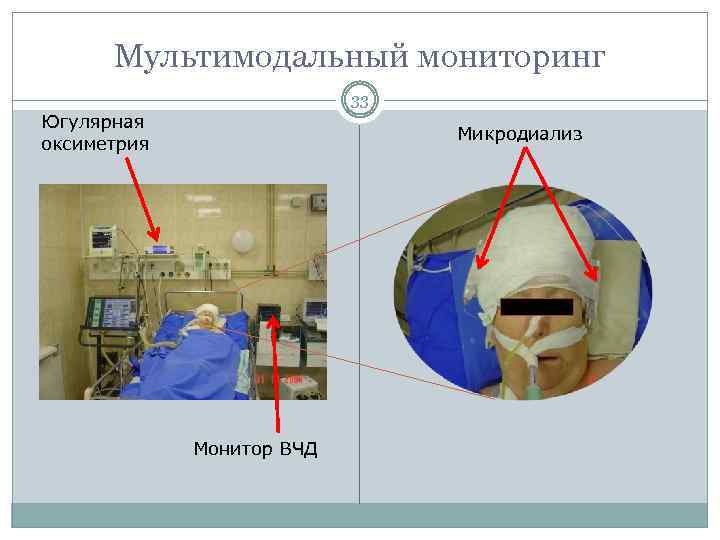 Мультимодальный мониторинг 33 Югулярная оксиметрия Микродиализ Монитор ВЧД 