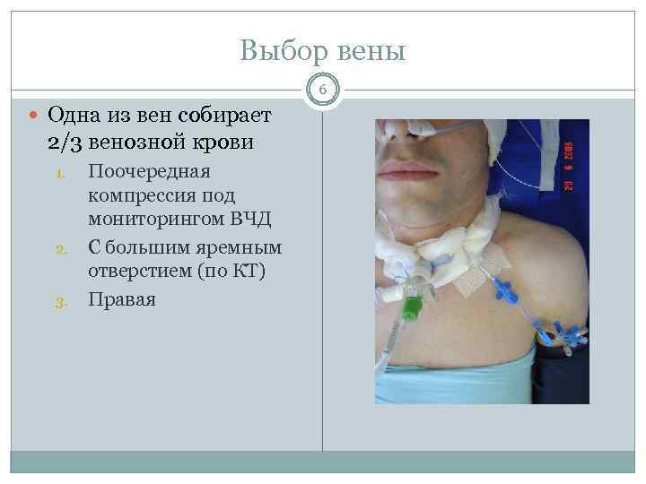 Выбор вены 6 Одна из вен собирает 2/3 венозной крови 1. 2. 3. Поочередная