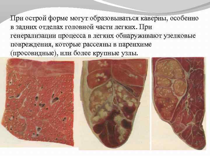 При острой форме могут образовываться каверны, особенно в задних отделах головной части легких. При