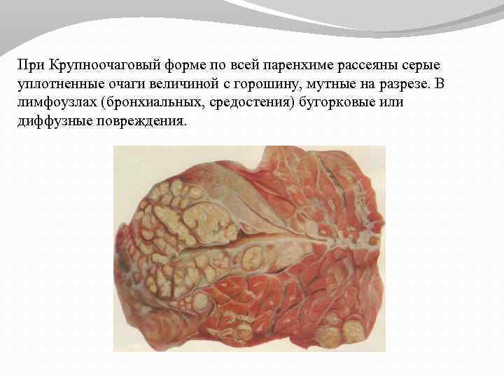 При Крупноочаговый форме по всей паренхиме рассеяны серые уплотненные очаги величиной с горошину, мутные