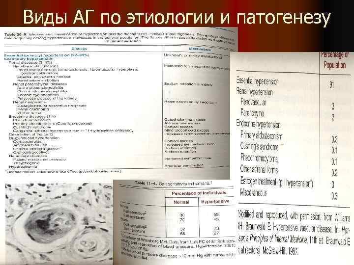 Виды АГ по этиологии и патогенезу 