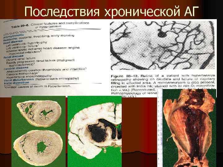 Последствия хронической АГ 