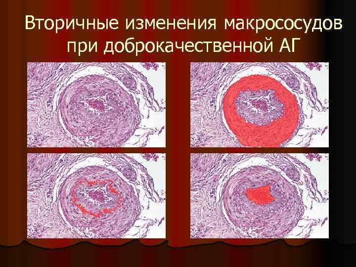 Вторичные изменения макрососудов при доброкачественной АГ 