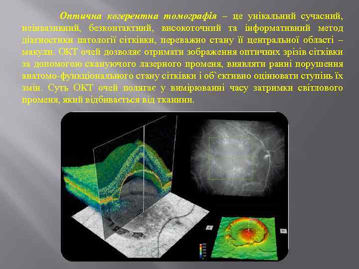 Оптична когерентна томографія – це унікальний сучасний, неінвазивний, безконтактний, високоточний та інформативний метод діагностики