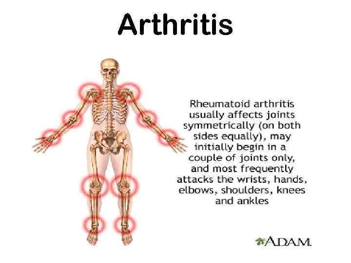 Arthritis 