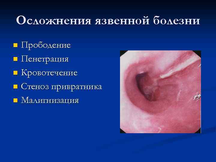 Осложнения язвенной болезни Прободение n Пенетрация n Кровотечение n Стеноз привратника n Малигнизация n
