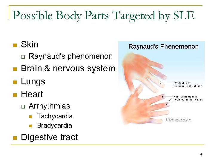 Possible Body Parts Targeted by SLE n Skin q n n n Raynaud’s phenomenon