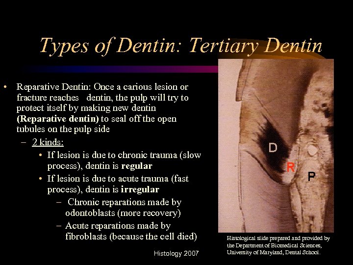 Types of Dentin: Tertiary Dentin • Reparative Dentin: Once a carious lesion or fracture