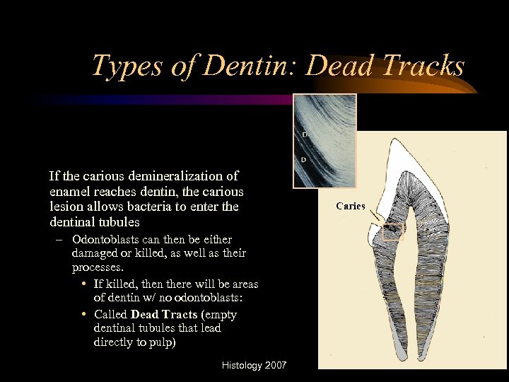 Types of Dentin: Dead Tracks If the carious demineralization of enamel reaches dentin, the