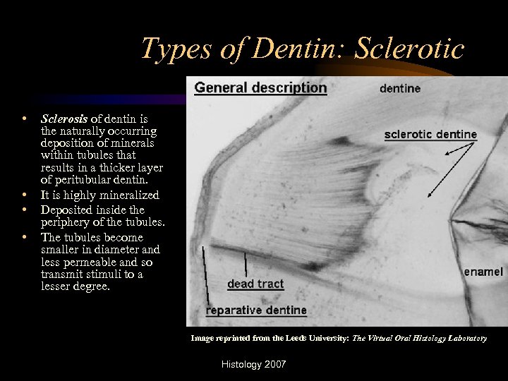 Types of Dentin: Sclerotic • • Sclerosis of dentin is the naturally occurring deposition