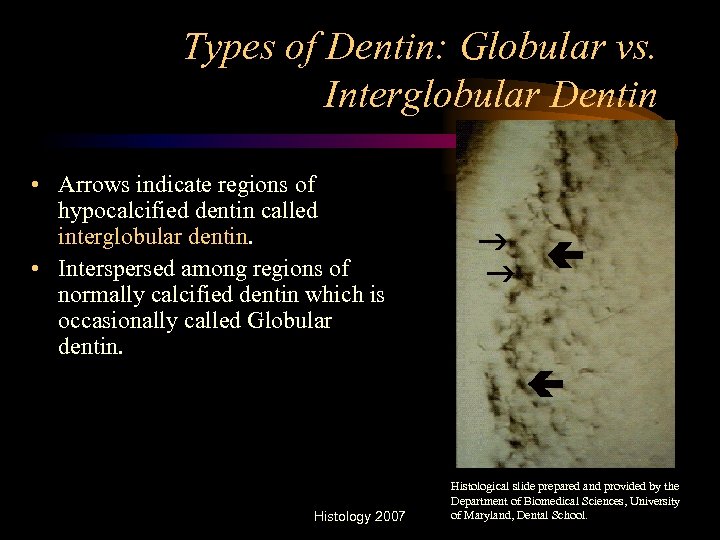 Types of Dentin: Globular vs. Interglobular Dentin • Arrows indicate regions of hypocalcified dentin