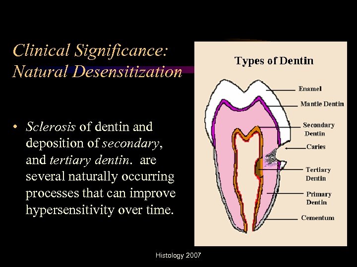 Clinical Significance: Natural Desensitization • Sclerosis of dentin and deposition of secondary, and tertiary