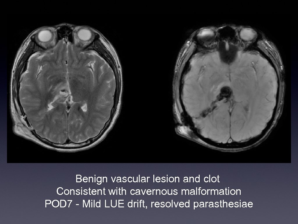 Benign vascular lesion and clot Consistent with cavernous malformation POD 7 - Mild LUE