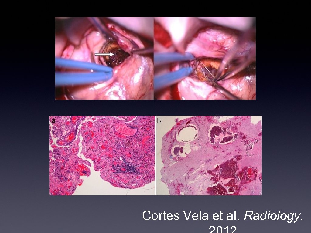 Cortes Vela et al. Radiology. 