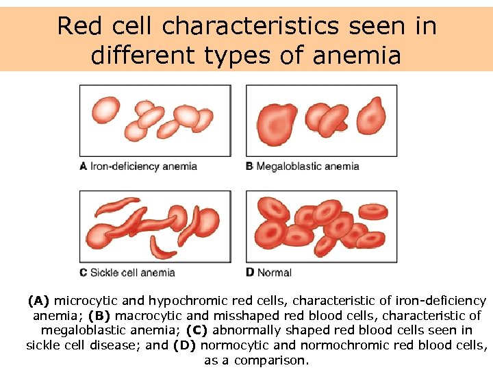 Red cell characteristics seen in different types of anemia (A) microcytic and hypochromic red