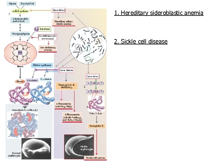 1. Hereditary sideroblastic anemia 2. Sickle cell disease 