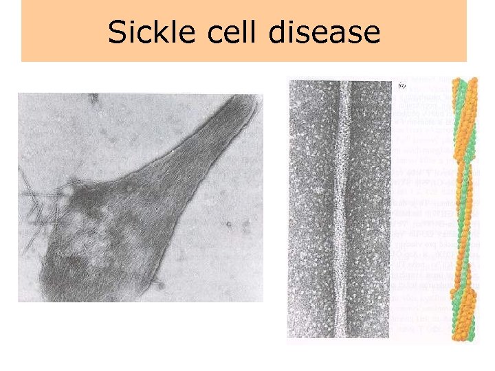 Sickle cell disease 