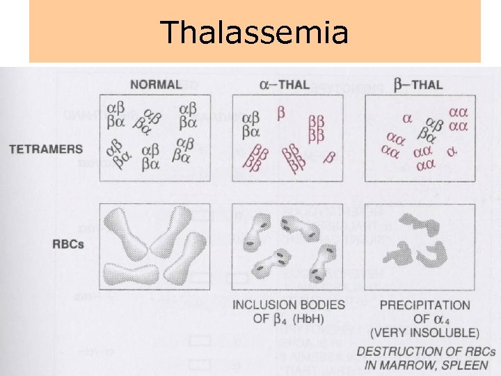 Thalassemia 