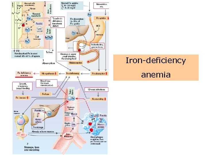 Iron-deficiency anemia 