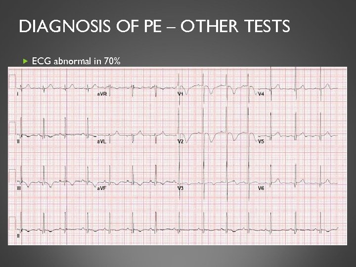 DIAGNOSIS OF PE – OTHER TESTS ECG abnormal in 70% Sinus tachycardia most common