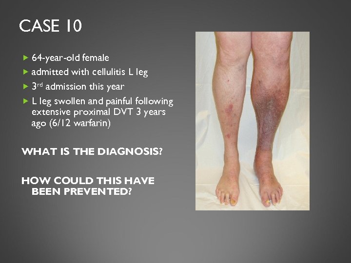 CASE 10 64 -year-old female admitted with cellulitis L leg 3 rd admission this