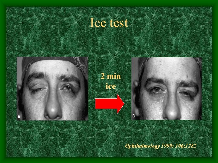 Ice test 2 min ice Ophthalmology 1999: 106: 1282 