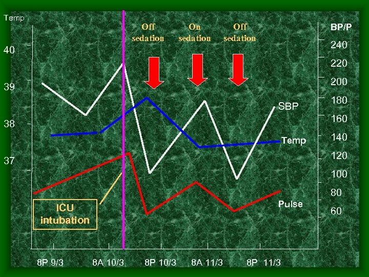 Temp Off sedation On sedation BP/P Off sedation 240 40 220 200 39 SBP