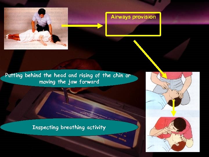 Airways provision Putting behind the head and rising of the chin or moving the