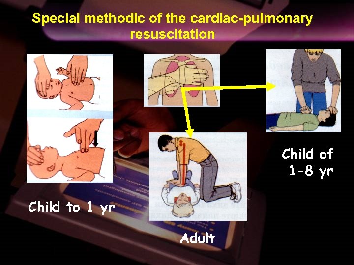 Special methodic of the cardiac-pulmonary resuscitation Child of 1 -8 yr Child to 1