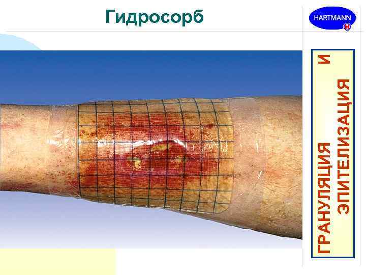 ГРАНУЛЯЦИЯ И ЭПИТЕЛИЗАЦИЯ Гидросорб 