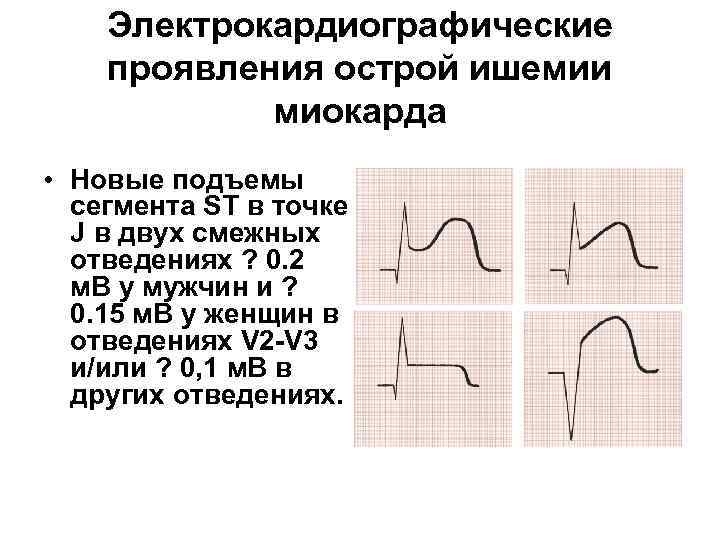 Конкордантный подъем сегмента. Элевация сегмента St на ЭКГ. Корытообразная депрессия сегмента St на ЭКГ.