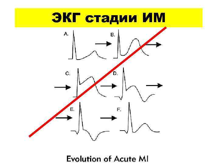ЭКГ стадии ИМ 