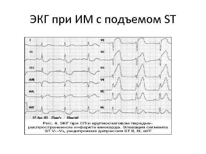 ЭКГ при ИМ с подъемом ST 