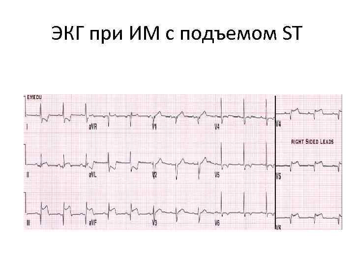ЭКГ при ИМ с подъемом ST 