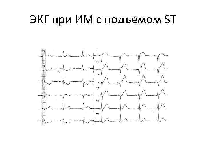 ЭКГ при ИМ с подъемом ST 