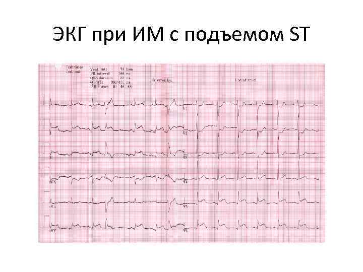 ЭКГ при ИМ с подъемом ST 