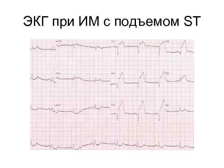 Конкордантный подъем st. Окс без подъема St на ЭКГ. Острый коронарный синдром ЭКГ.