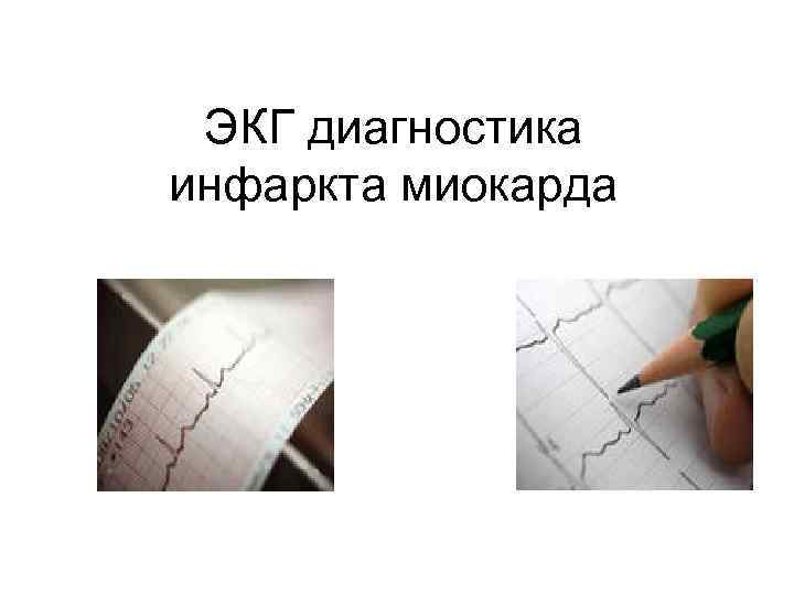 ЭКГ диагностика инфаркта миокарда 