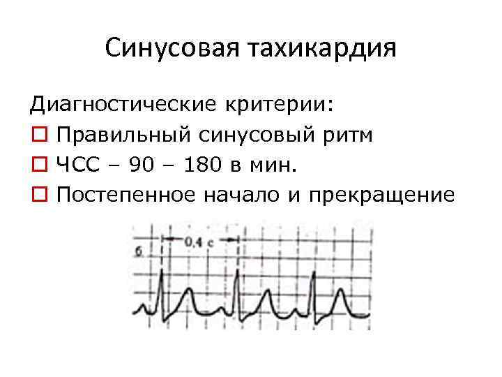 Синусовая тахикардия что